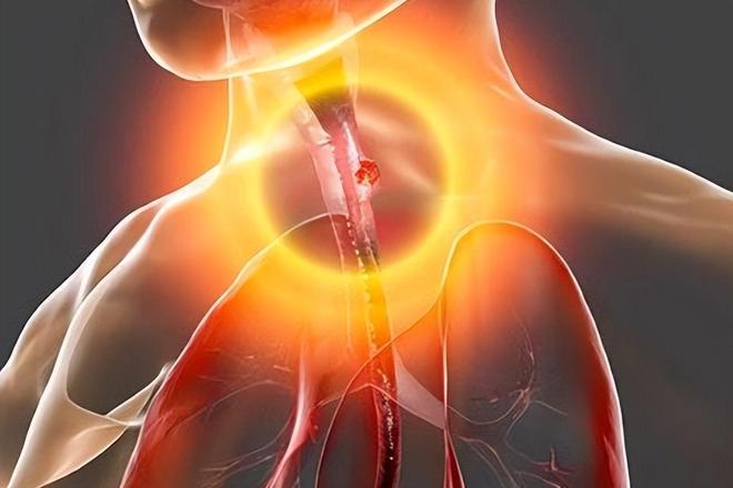 全球一半食管癌在中国？再次忠告：家中这3类食物尽早撤下餐桌(图1)