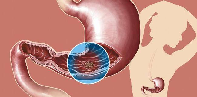 被称为“烂胃王”kaiyun体育全站的四类型蔬菜多吃胃病越沉早日从餐桌上撤下(图2)