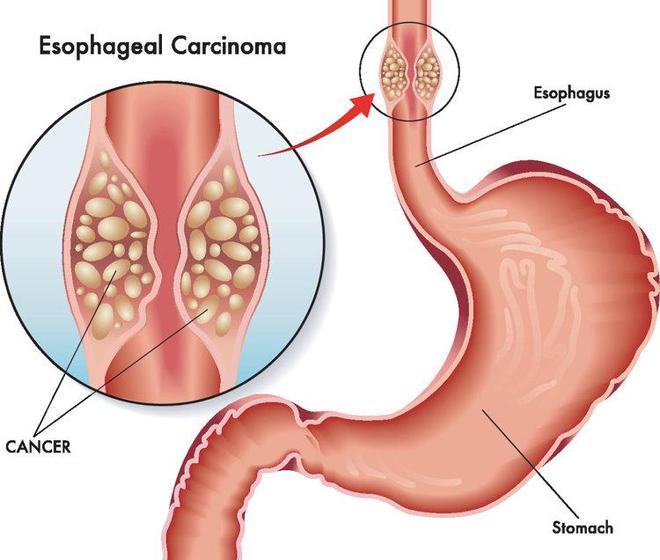 kaiyun体育网页版全球一半食管癌在中国！再次提醒：家中4种食物尽快撤下餐桌(图6)
