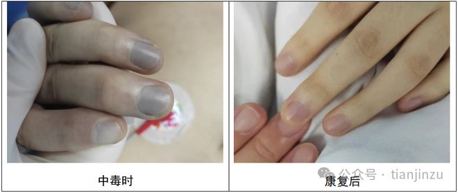 开云体育全身抽搐男子紧急抢救！严重可致死天津人餐桌上常见(图5)